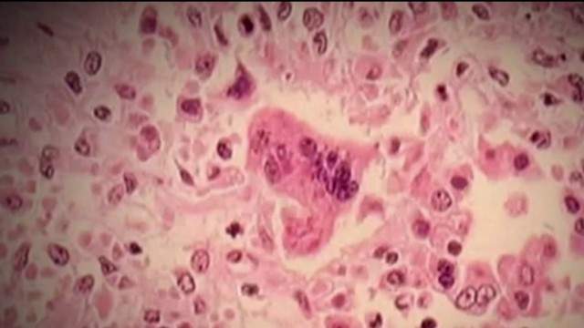 Washtenaw County Measles Case Cleared After More Testing