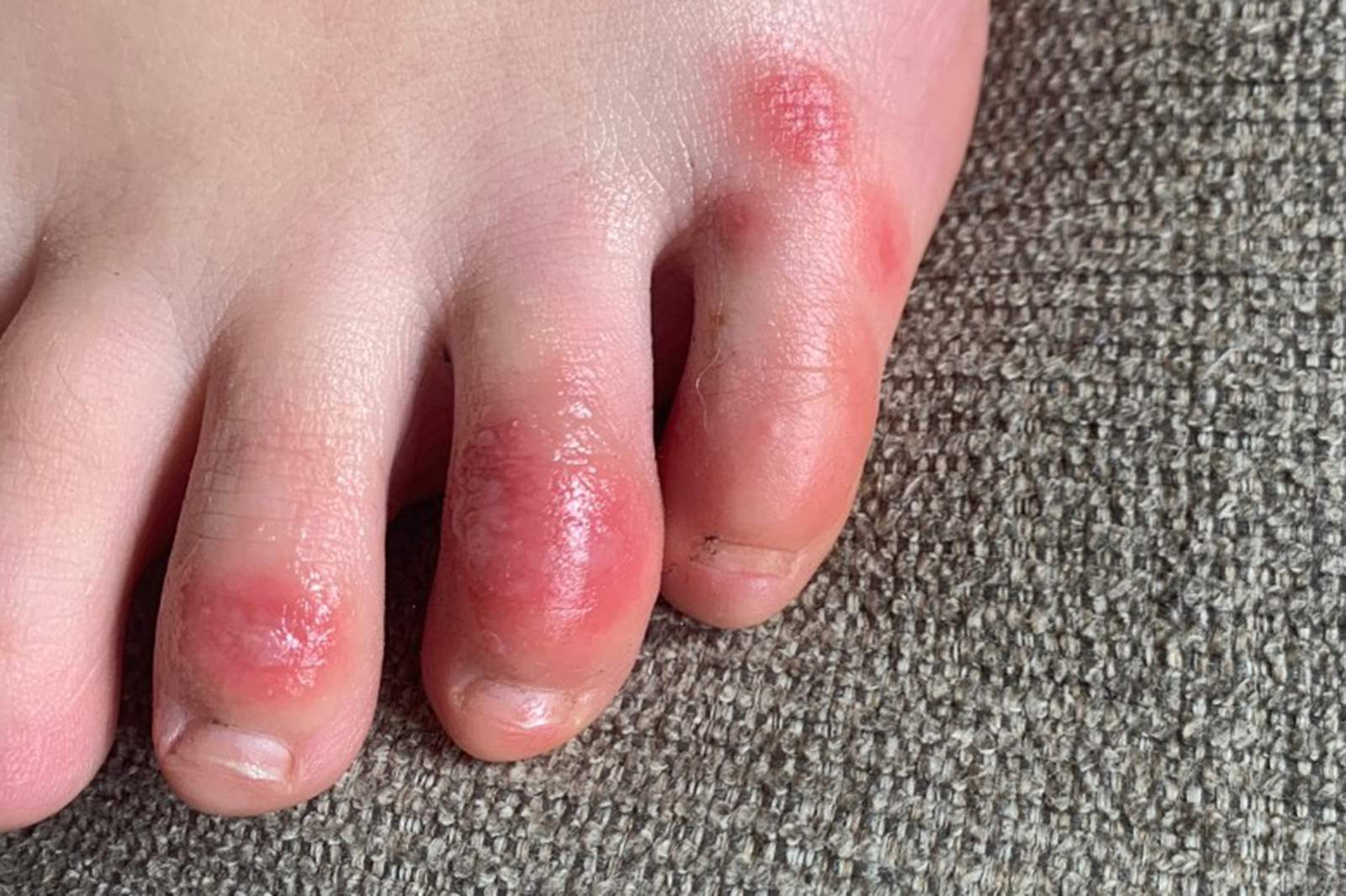 New research finds that ‘COVID toes’ could last for 150 days