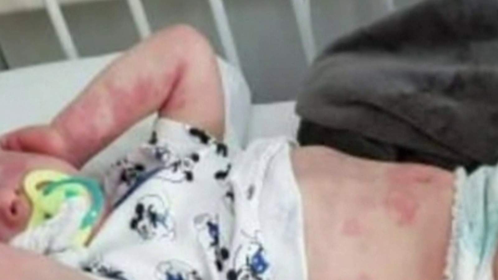 Doctors on alert for mysterious syndrome in children believed to be linked to COVID-19