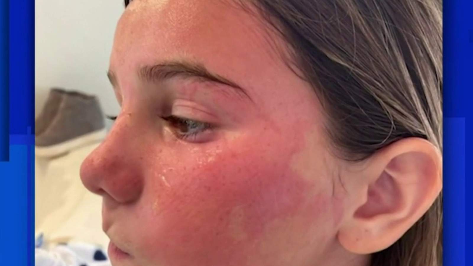 Mother speaks out after child suffers serious reaction from face mask