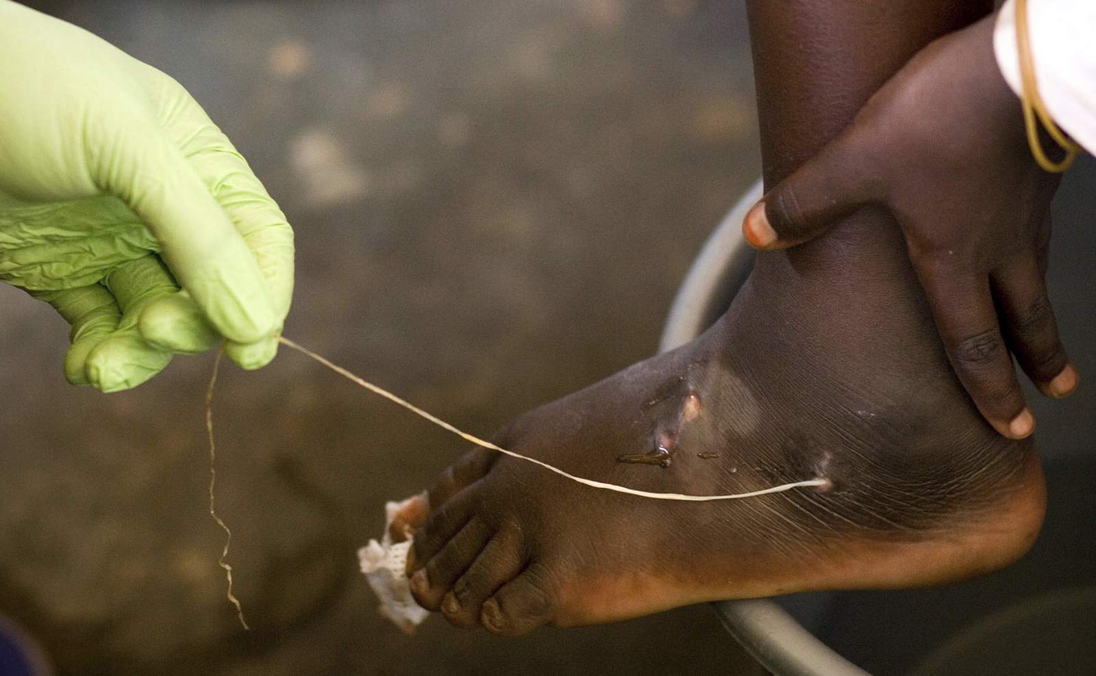 Guinea worm closer to eradication as cases halve in a year